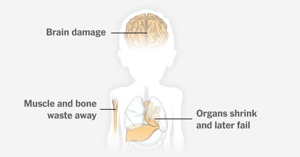 Para los niños de Gaza, la desnutrición aguda podría causar una vida de desafíos de salud